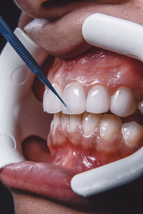 From Consultation to Confidence: Understanding the Complete Smile Makeover Process